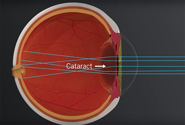 Cataract eye graphic at Bochner Eye Institute in Toronto