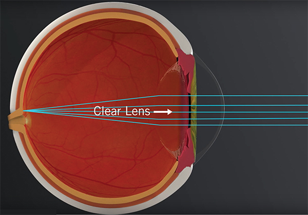 Laser Cataract Surgery Toronto